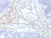 IHC: Formalin-fixed, paraffin-embedded colon carcinoma stained with CD31 antibody cocktail  (C31.3+C31.7+C31.10).