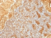 IHC: Formalin-fixed, paraffin-embedded human salivary tumor stained with Cytochrome C antibody (clone SPM389).