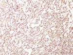 IHC: Formalin-fixed, paraffin-embedded human angiosarcoma stained with PODXL antibody (4F10).