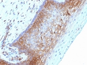 IHC: Formalin-fixed, paraffin-embedded human cervical carcinoma stained with Beta-2-Microglobulin antibody (clone B2M/1118).
