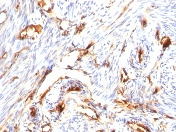 IHC: Formalin-fixed, paraffin-embedded human endometrial carcinoma stained with Beta-2-Microglobulin antibody (clone B2M/1118).~