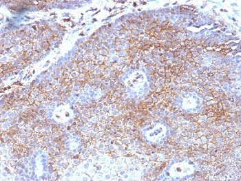 IHC: Formalin-fixed, paraffin-embedded human cervical carcinoma stained with Beta-2-Microglobulin antibody (
