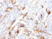 IHC: Formalin-fixed, paraffin-embedded human endometrial carcinoma stained with Beta-2-Microglobulin antibody (clone B2M/1118).