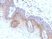 IHC: Formalin-fixed, paraffin-embedded human cervical carcinoma stained with B2M antibody (clone SPM617).