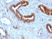 IHC: Formalin-fixed, paraffin-embedded human endometrial carcinoma stained with Beta-2-Microglobulin antibody (clone B2M/961).