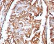 IHC: Formalin-fixed, paraffin-embedded human renal carcinoma stained with Beta-2-Microglobulin antibody (clone B2M/961).