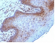 IHC: Formalin-fixed, paraffin-embedded human cervical carcinoma stained with Beta-2-Microglobulin antibody (clone B2M/961).