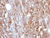 IHC: Formalin-fixed, paraffin-embedded human cervical carcinoma stained with Beta-2-Microglobulin antibody (clone B2M/961).
