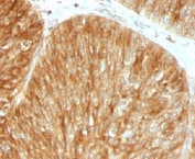 IHC: Formalin-fixed, paraffin-embedded human bladder carcinoma stained with Beta-2-Microglobulin antibody (clone B2M/961).