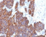 IHC: Formalin-fixed, paraffin-embedded human parathyroid stained with Parathyroid Hormone antibody (clone PTH/1173).