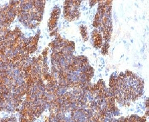 IHC: Formalin-fixed, paraffin-embedded human parathyroid stained with Parathyroid Hormone antibody (clone PTH/1173).