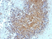 IHC: Formalin-fixed, paraffin-embedded human melanoma stained with Bax antibody (clone BAX/962).
