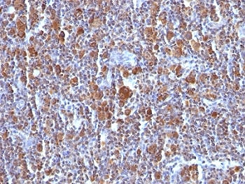 IHC: Formalin-fixed, paraffin-embedded Hodgkin's lymphoma stained with Bax antibody (clone BAX/962).~