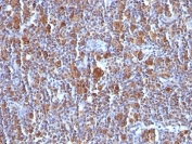 IHC: Formalin-fixed, paraffin-embedded Hodgkin's lymphoma stained with Bax antibody (clone BAX/962).
