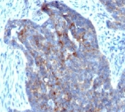 IHC: Formalin-fixed, paraffin-embedded human ovarian carcinoma stained with RBP1 (clone RBP/872).