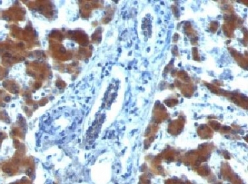 IHC: Formalin-fixed, paraffin-embedded human hepatocellular carcinoma stained with RBP1 (clone RBP/872).~