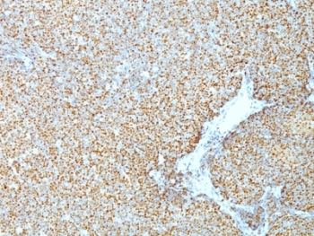 IHC: Formalin-fixed, paraffin-embedded human mantle cell lymphoma stained with Cyclin D1 antibody (CCND1/809).~