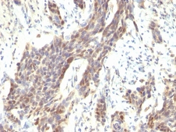 IHC: Formalin-fixed, paraffin-embedded human bladder carcinoma stained with Cyclin D1 antibody (CCND1/809).