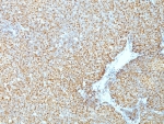 IHC: Formalin-fixed, paraffin-embedded human mantle cell lymphoma stained with Cyclin D1 antibody (CCND1/809).