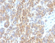 IHC: Formalin-fixed, paraffin-embedded human melanoma stained with Bcl2 antibody (BCL2/782).