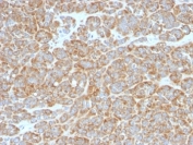 IHC: Formalin-fixed, paraffin-embedded human melanoma stained with Bcl-2 antibody (BCL2/796).
