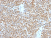 IHC: Formalin-fixed, paraffin-embedded human melanoma stained with Bcl-2 antibody.