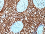 IHC: Formalin-fixed, paraffin-embedded human non-Hodgkin's lymphoma stained with Bcl-2 antibody (BCL2/782 + BCL2/796).