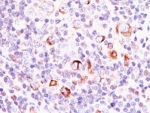 IHC: Formalin-fixed, paraffin-embedded human Hodgkin's lymphoma stained with Bcl-X antibody (SPM337).