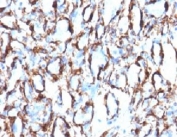 IHC: Formalin-fixed, paraffin-embedded human angiosarcoma stained with alpha Smooth Muscle Actin antibody (clone ACTA2/791).