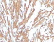 IHC: Formalin-fixed, paraffin-embedded human Leiomyosarcoma stained with alpha Smooth Muscle Actin antibody (clone ACTA2/791).