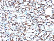 IHC: Formalin-fixed, paraffin-embedded human angiosarcoma stained with ACTA2 antibody cocktail (clone 1A4 + ACTA2/791).