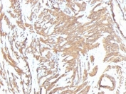 IHC: Formalin-fixed, paraffin-embedded human leiomyosarcoma stained with ACTA2 antibody cocktail (clone 1A4 + ACTA2/791).