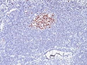 IHC testing of formalin-fixed, paraffin-embedded human lymphoma stained with anti-Bcl6 antibody (clone SPM602).~