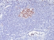 IHC testing of formalin-fixed, paraffin-embedded human lymphoma stained with anti-Bcl6 antibody (clone SPM602).