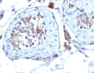 IHC: Formalin-fixed, paraffin-embedded human testicular carcinoma stained with SHBG antibody (clone SHBG/245).~