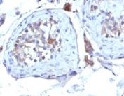 IHC: Formalin-fixed, paraffin-embedded human testicular carcinoma stained with SHBG antibody (clone SHBG/245).