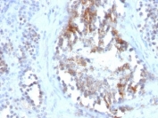 IHC: Formalin-fixed, paraffin-embedded human testicular carcinoma stained with SHBG antibody (clone SPM605).