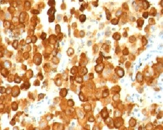 IHC: Formalin-fixed, paraffin-embedded human melanoma stained with PMEL17 antibody (PMEL/783).~