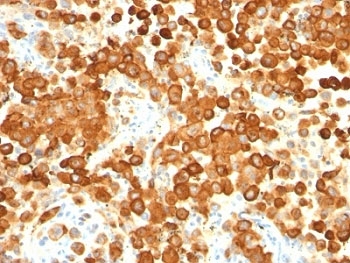 IHC: Formalin-fixed, paraffin-embedded human melanoma stained with gp100 antibody cocktail (HMB45 + PMEL/783). HIER: boil tissue sections in pH 9 10mM Tris with 1mM EDTA for 20 min and allow to cool before testing.~