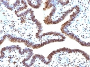 IHC: Formalin-fixed, paraffin-embedded human ovarian carcinoma stained with SUMO-2 antibody.