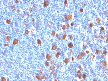 IHC: Formalin-fixed, paraffin-embedded human Hodgkin's lymphoma stained with Fascin antibody (FSCN1/416)~