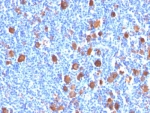 IHC: Formalin-fixed, paraffin-embedded human Hodgkin's lymphoma stained with Fascin antibody (FSCN1/416)