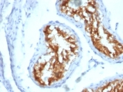 IHC: Formalin-fixed, paraffin-embedded human testicular carcinoma stained with Fascin antibody (clone FSCN1/417).