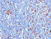 IHC: Formalin-fixed, paraffin-embedded human Hodgkin's lymphoma stained with Fascin antibody (clone FSCN1/417).