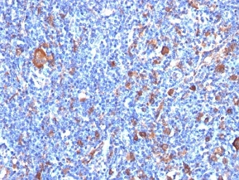 IHC: Formalin-fixed, paraffin-embedded human Hodgkin's lymphoma stained with Fascin antibody (clone FSCN1/417).