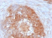 IHC: Formalin-fixed, paraffin-embedded human ovarian carcinoma stained with Fascin antibody (clone FSCN1/417).