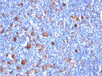 IHC analysis of formalin-fixed, paraffin-embedded human Hodgkin's lymphoma stained with Fascin antibody (clone SPM133).~