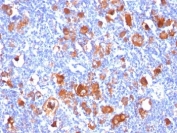 IHC: Formalin-fixed, paraffin-embedded human Hodgkin's lymphoma stained with Fascin antibody (FSCN1/418)