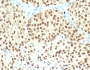 IHC: Formalin-fixed, paraffin-embedded human melanoma stained with SOX10 antibody (clone SPM607).