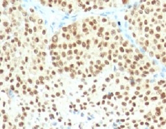 IHC: Formalin-fixed, paraffin-embedded human melanoma stained with SOX10 antibody (SPM607).